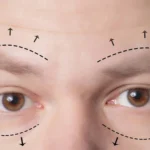 blepharoplasty