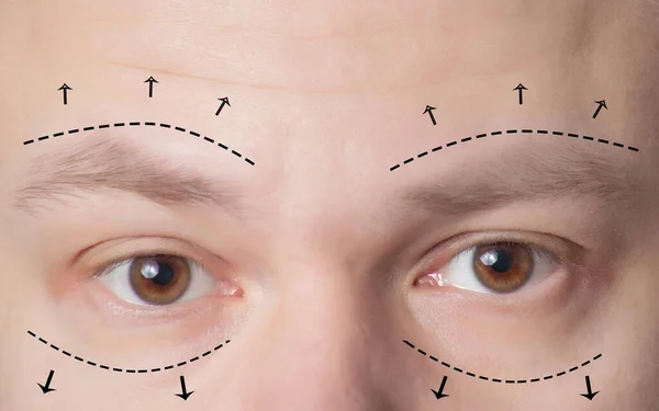blepharoplasty