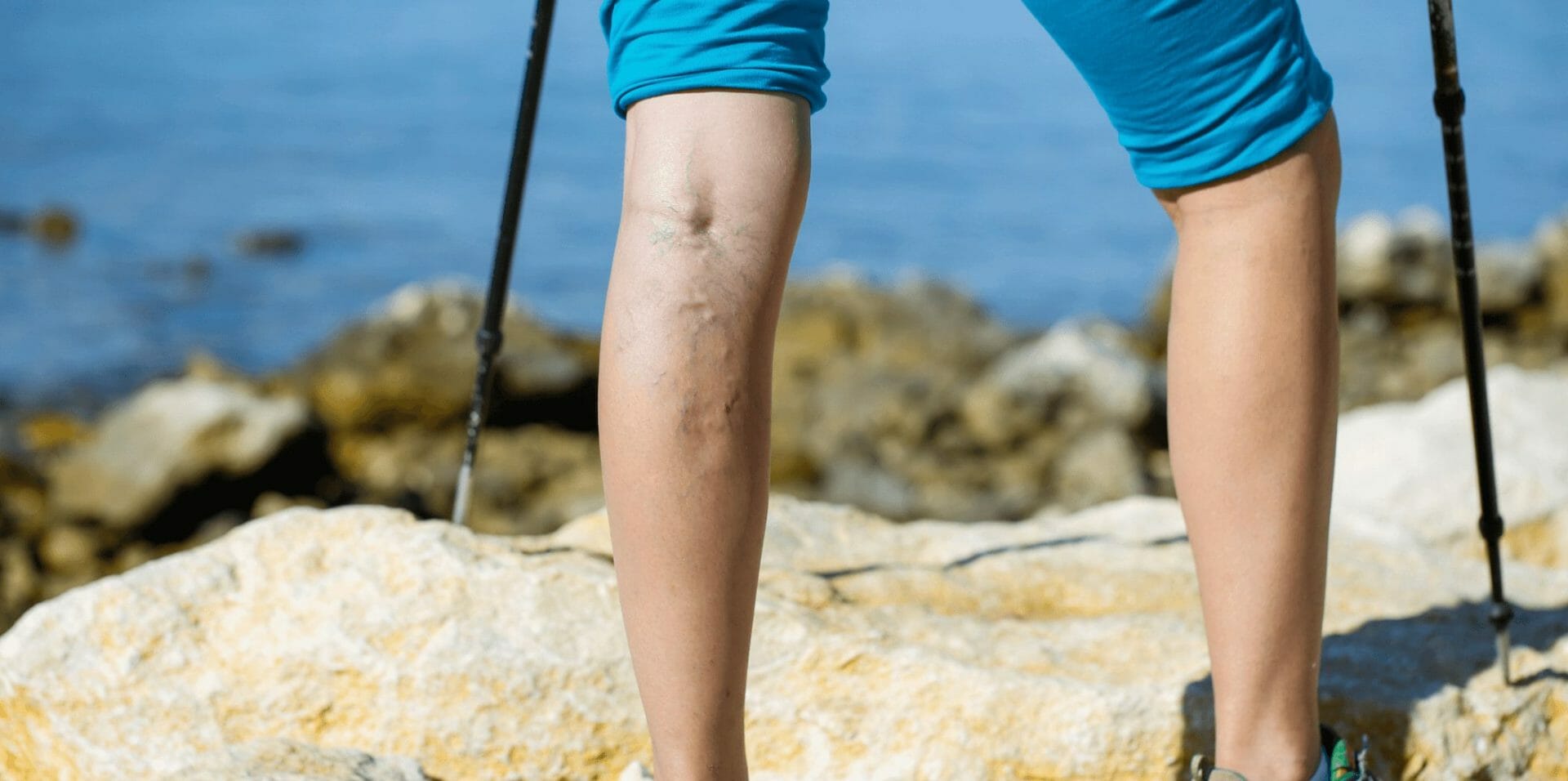 Varicose vein treatment in sunningdale 1.jpg
