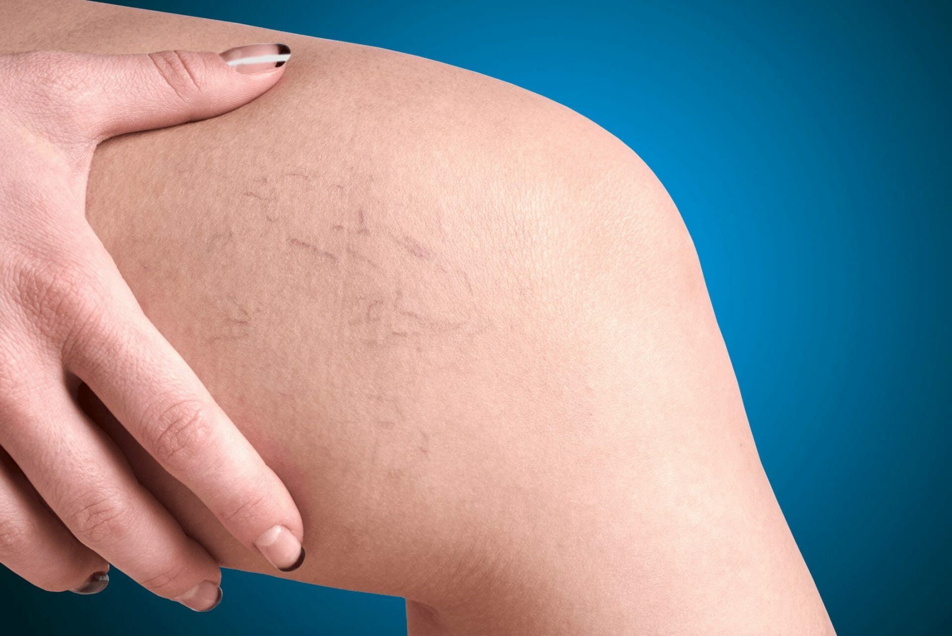 Varicose vein treatment in sunningdale.jpg